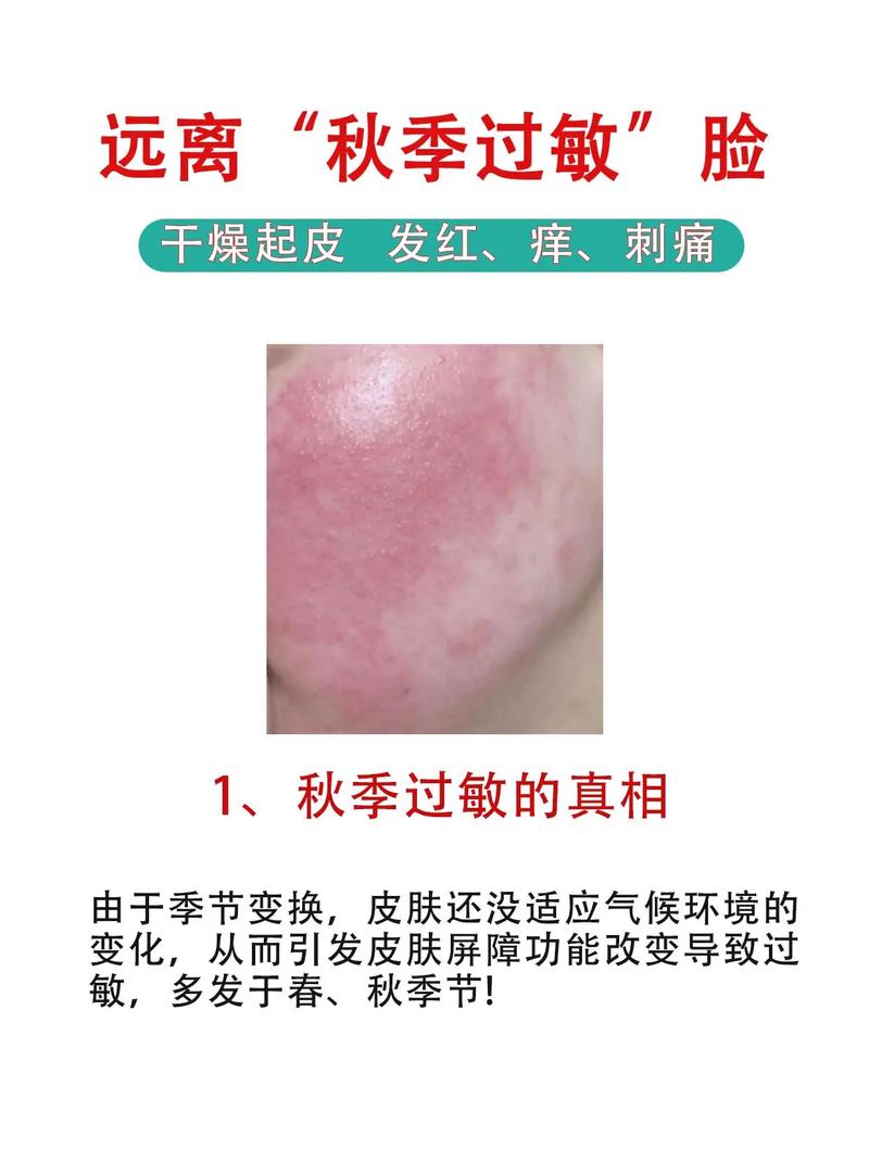 过敏应对(过敏采取什么措施)