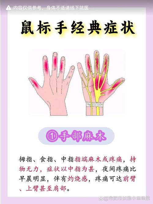 鼠标手职业病\(鼠标手职业病 新华社图片)